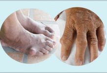 Como controlar os níveis de ácido úrico