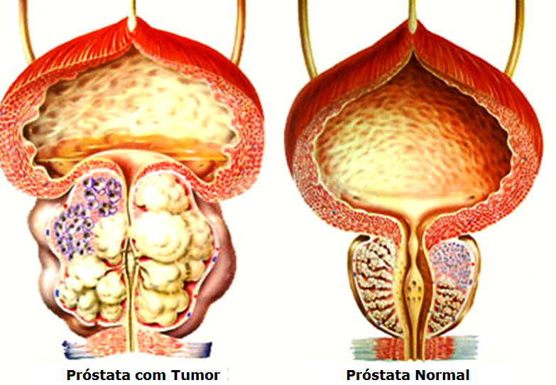 Простата это предстательная. Злокачественная аденома простаты. Простатит, доброкачественная гиперплазия предстательной железы.