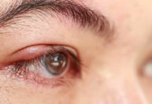 Terçol: causas, sintomas e tratamento